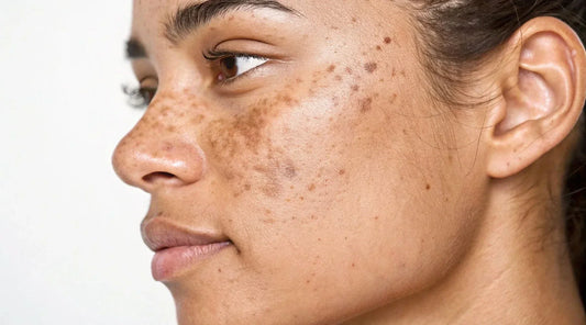 Before and after results of effective dark spot treatments on skin