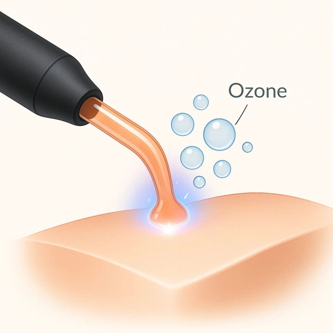How high frequency wand creates ozone on skin – illustration of acne-killing antibacterial effect